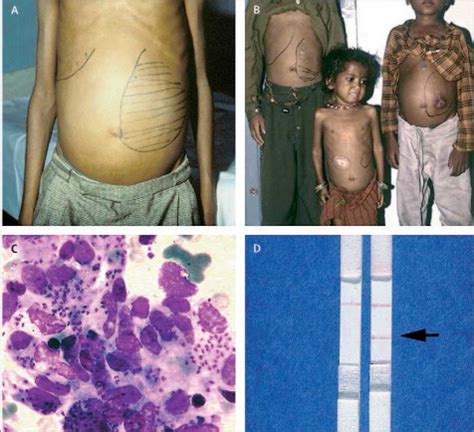 Advances in leishmaniasis - The Lancet