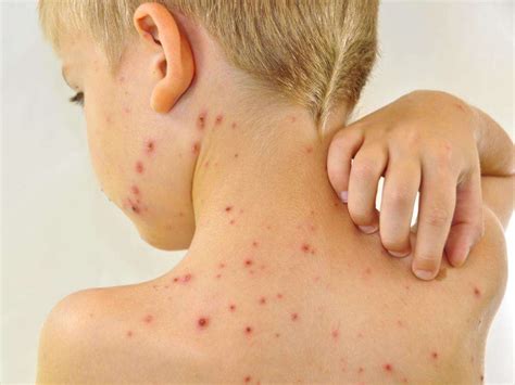 Chicken Pox: 10 Chicken Pox Symptoms