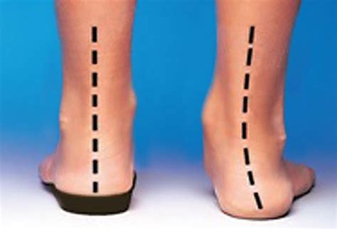 flat feet surgery pros and cons - gongalves