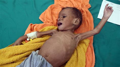 Estimated 85,000 Children Under 5 Years Old May Have Died of Hunger in Yemen: Aid Group | KTLA