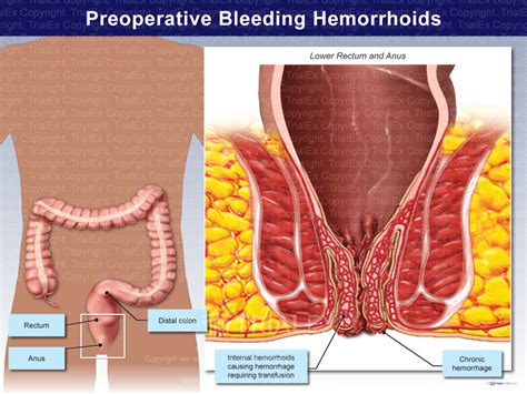 Preoperative Bleeding Hemorrhoids - TrialQuest Inc.