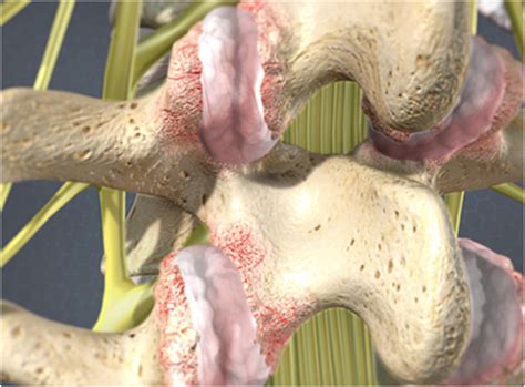 Mri Lumbar Facet Joint