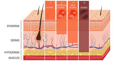 Three Main Layers Of Skin Burns