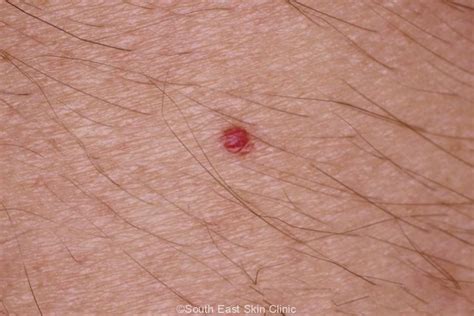 Haemangioma - South East Skin Clinic