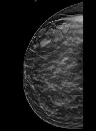 Breast hamartoma | Radiology Reference Article | Radiopaedia.org