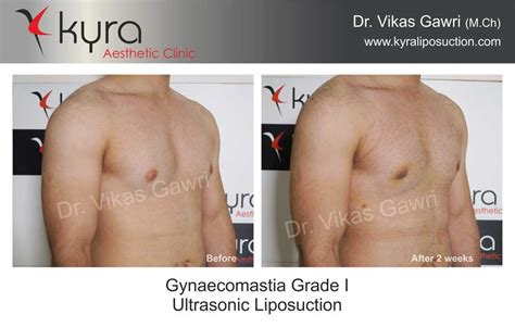 Advanced Liposuction - Cosmetic Surgery in Ludhiana, Plastic Surgery in ...