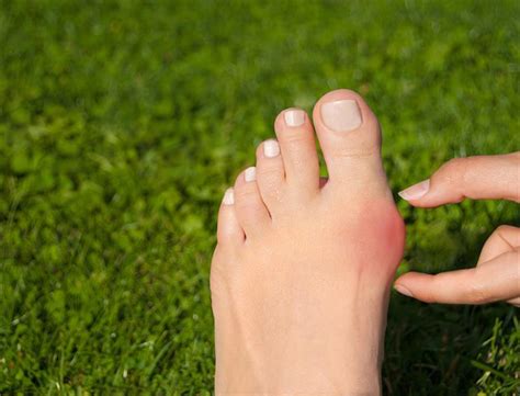 Common Foot Problems: Corns, Calluses and Bunions