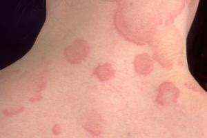 Urticaria (hives) | nidirect