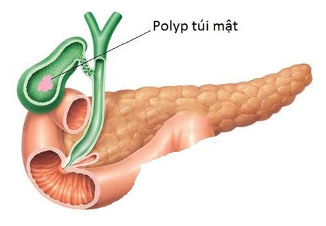 Does 6mm gallbladder polyp need surgery? | Vinmec