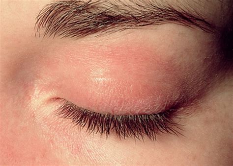 Red Rash On Eyelids | Images and Photos finder