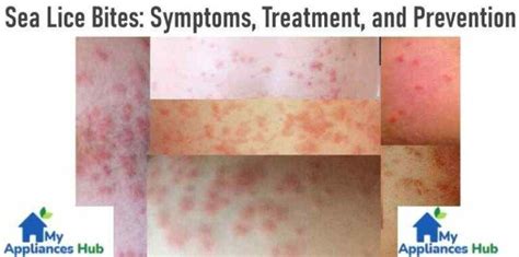 Sea Lice Bites: Symptoms, Treatment, and Prevention