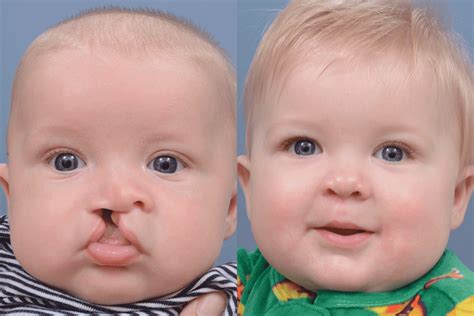 Cleft Lip Correction Before & After Photos - Ernesto J. Ruas MD