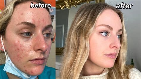 Accutane Before During And After