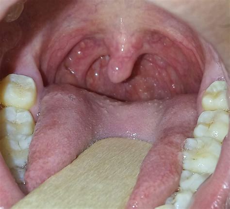 Albums 99+ Wallpaper Pictures Of Healthy Tonsils In Adults Latest