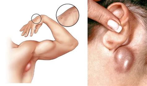 Enlarged lymph nodes are common symptoms of a Bartonella henselae... | Download Scientific Diagram