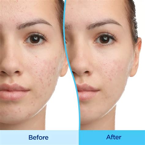 Differin Gel Acne Treatment 0.1% Adapalene - Shop Facial Masks & Treatments at H-E-B