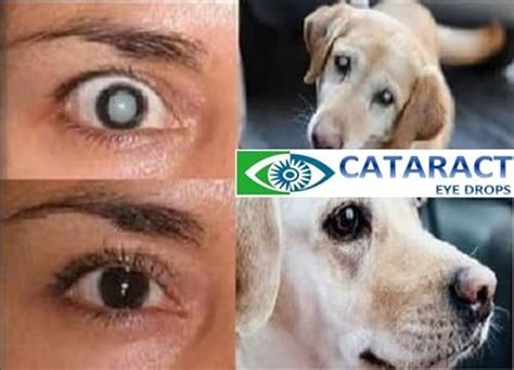 Best Eye Drops For Cataracts In Humans