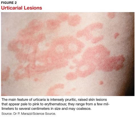 Urticaria Rash Causes