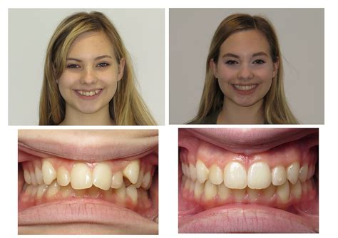 Can Invisalign Actually Fix An Overbite? - Impact Orthodontics