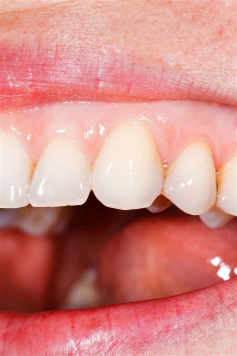 Pale gums: Causes, symptoms, treatment, and warning signs