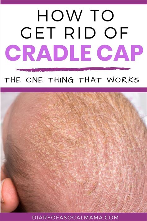 Cradle Cap: the Best way to get rid of it! | Cradle cap, Cradle cap remedies, Cradle cap ...