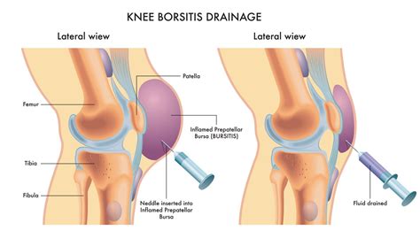 Bursitis | Knee Surgeon Dr A Theodorides - Symptoms, Diagnosis, Treatment