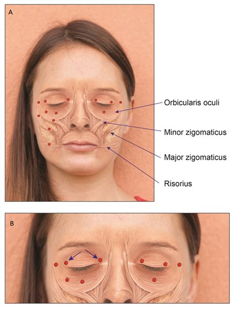 Toxins | Free Full-Text | Therapeutic Approach to Botulinum Injections ...