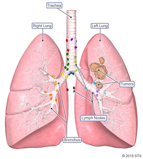 Lung Cancer | The Patient Guide to Heart, Lung, and Esophageal Surgery