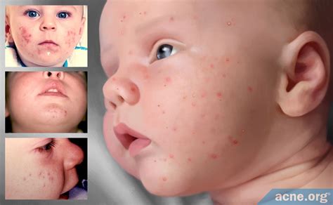 Causes And Treatments For Baby Acne