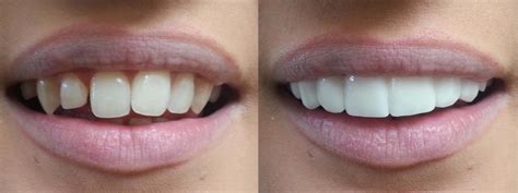 clip-on-veneers-bleach-shade-before-afters | Lakeview Dental