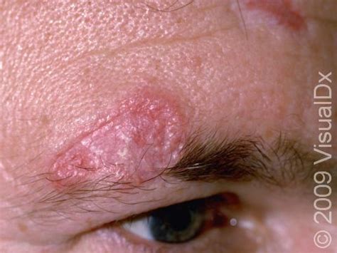 Discoid Lupus Erythematosus Condition, Treatments and Pictures for Adults - Skinsight