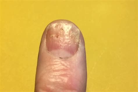 Psoriasis in the fingernails and toenails