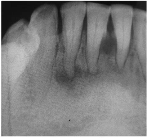 FOCAL CEMENTO-OSSEOUS DYSPLASIA PDF