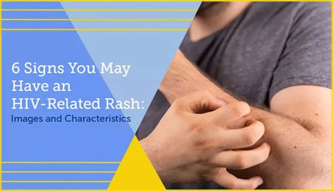 6 Signs You May Have an HIV-Related Rash: Images and Characteristics | myHIVteam