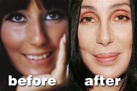 Celebrity Cher Plastic Surgery Before And After - CELEB-SURGERY.COM