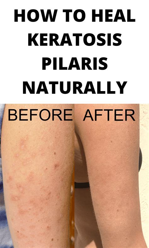 How to Heal Keratosis Pilaris Pilaris from the Inside Out - Pure and ...