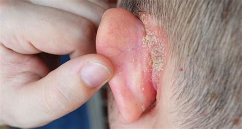 Eczema: Managing the itchy ears – Astra Hearing Aid Center – in Chennai, Madurai, Salem