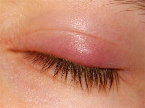Eyelid Redness Causes, Symptoms, Inflamed, Dry Itchy Swollen Red ...