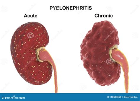 Pielonefritis Aguda Y Cronica | Porn Sex Picture