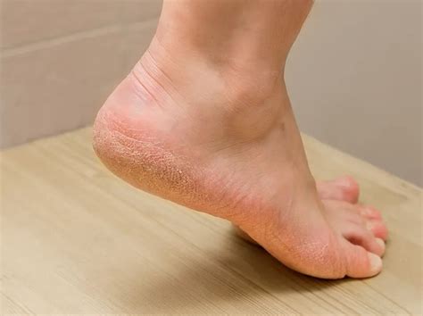 Understanding Dry Feet Causes and Solutions Guide