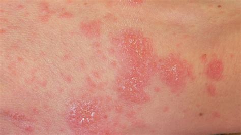 Rash In Groin Area Female : Inverse psoriasis or jock itch? Symptoms ...