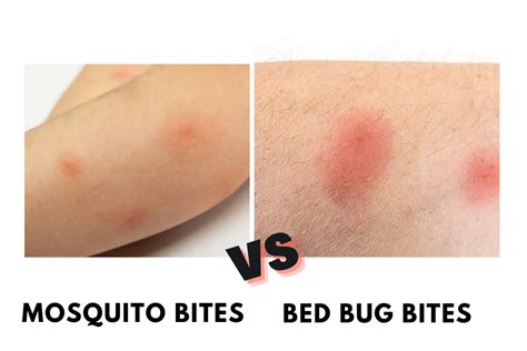 Bed Bug Bite vs Mosquito Bite - PestQueen