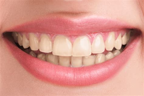 Dallas Teeth Whitening - Best Price On Teeth Whitening In Dallas, TX