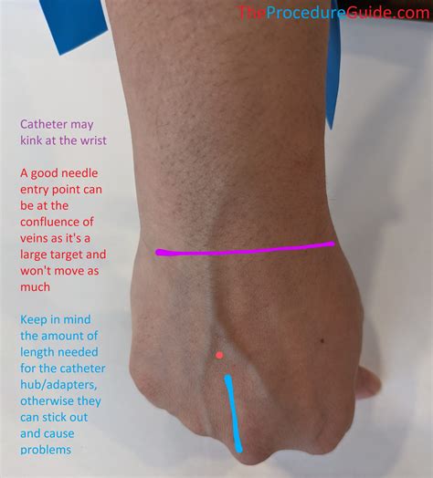 Intravenous Injection Sites