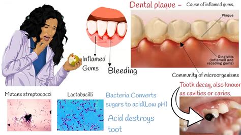 Bleeding gums - Understanding of Tooth decay, cavities and caries. - YouTube