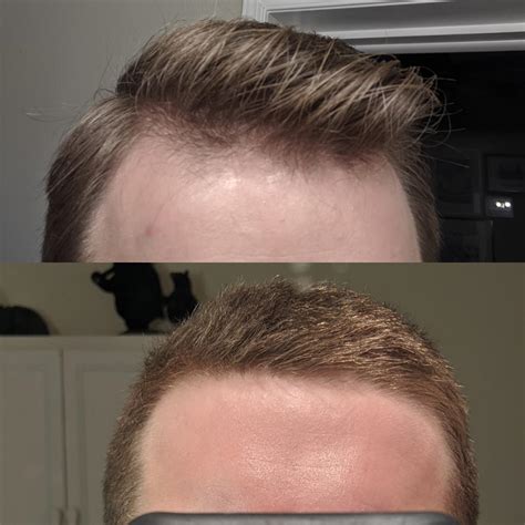 6 Month Hair Progress/Growth (Full Imgur Album in comments) : r/tressless