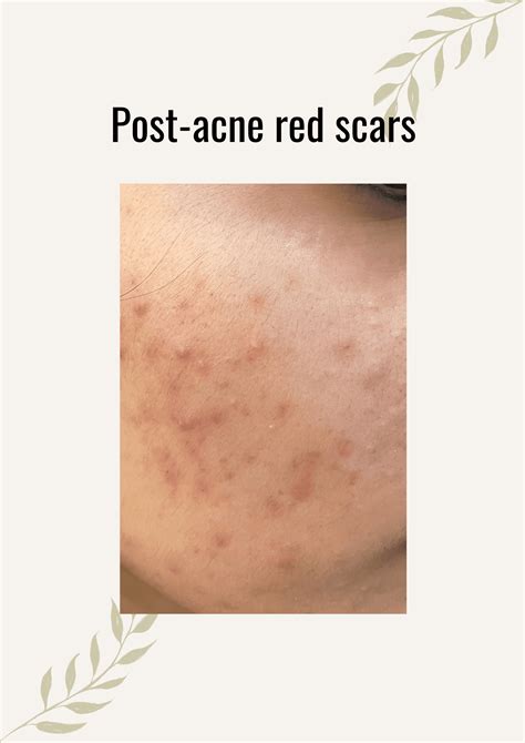 Red acne scars treatment - Dermatocare