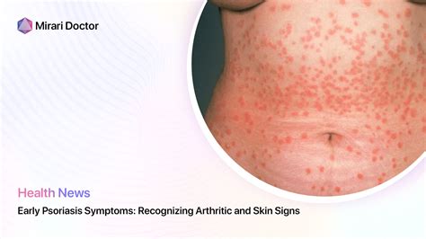 Early Psoriasis Symptoms: Recognizing Arthritic and Skin Signs