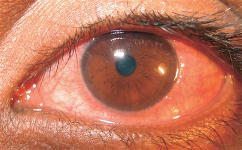 VERNAL KERATOCONJUNCTIVITIS (VKC) OR SPRING CATARRH