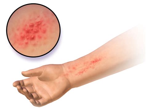 Three Common Causes of Hives - The Dermatology Clinic